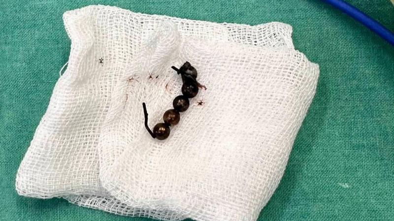 Подмосковные врачи спасли подростка, проглотившего магнитные шарики